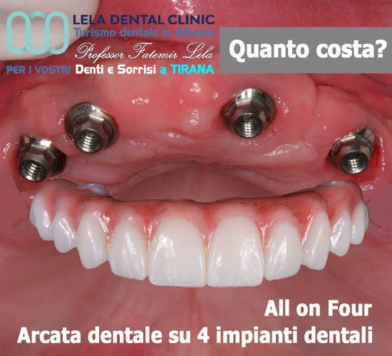 All on 4 Lela Dental Albania Tirana arcata fissa