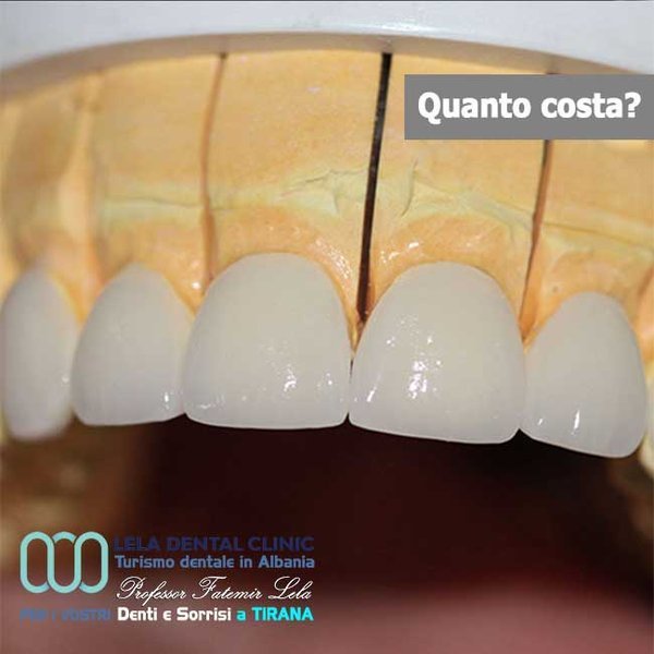 Corone in lega ceramica Lela Dental