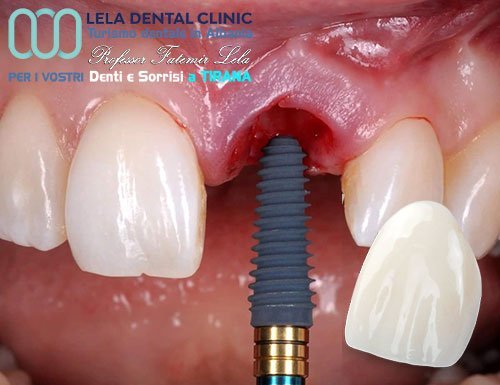 Impianto dentale singolo Lela Dental Tirana