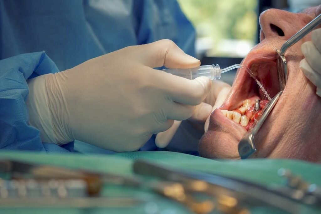 Mani che irrigano un sito orale secco durante un intervento implantare