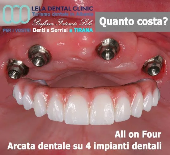 All on 4 Lela Dental Albania Tirana arcata fissa