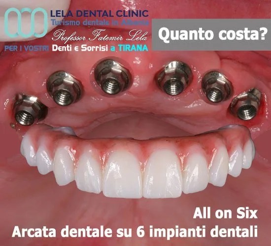 All on 6 Lela Dental Albania Tirana gold standard