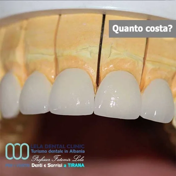 Corone in lega ceramica Lela Dental