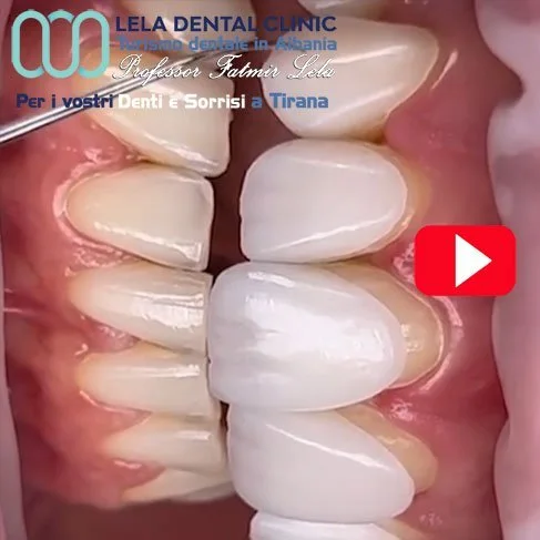 Faccette E.max ceramica integrale Lela Dental