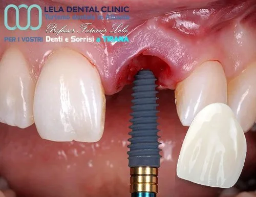 Impianto dentale singolo Lela Dental Tirana