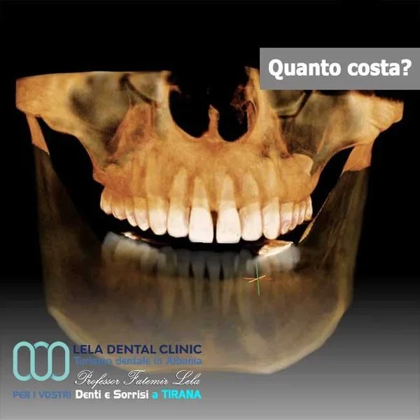 TAC 3D dentale per implantologia Lela Dental