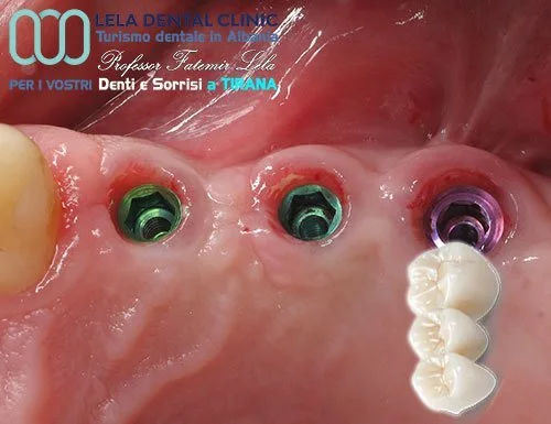 Materiali premium impianti Lela Dental
